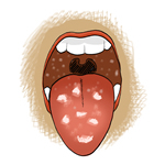 Des tâches blanches à la langue ou la bouche